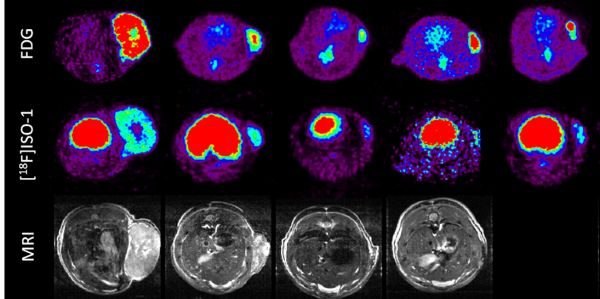 Positron emission tomography (PET) scans of a brain tumour