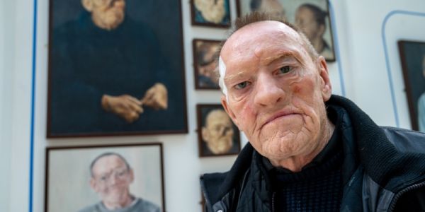 Trial contributor Robin wearing his facial prosthesis standing in front of his portraits in the Bexley Wing at St James' University Hospital, Leeds